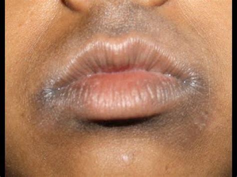 Mustache is a the personification of the extra hair in women which can occur on the cheeks, chest, arms, and legs.how to get rid of now, heat the mixture in a microwave for about 30 minutes until it turns brown. YouTube | Dark skin around mouth, Dark skin, Upper lip