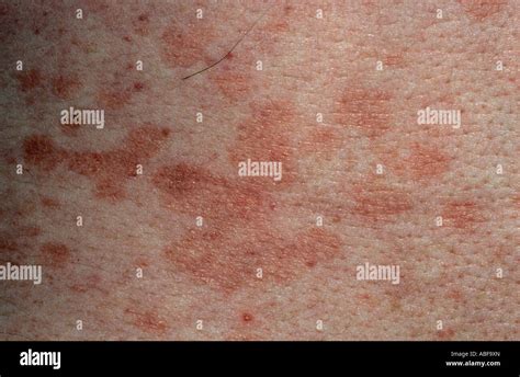 Pityriasis Rosea Type Skin Rash Foto Stock Shutterstock The Best Porn Website