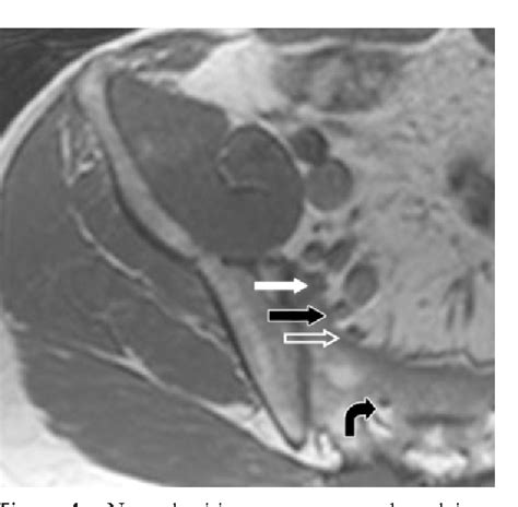 Mr Imaging Of Entrapment Neuropathies Of The Lower Extremity Part 1