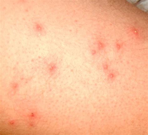 Folliculitis Pictures Symptoms Causes Treatment Hubpages