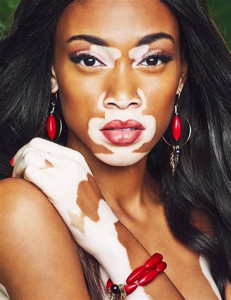 We did not find results for: 19 Times This Model With A Skin Condition Gave Us Life ...