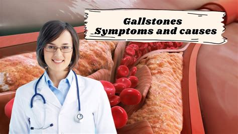Gallstones Symptoms And Causes Youtube