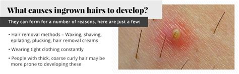 Can Laser Hair Removal Work For Ingrown Hairs Urbana