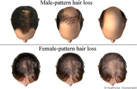 Among clinicians use the ludwig classification to describe female pattern hair loss. Does Low Testosterone Cause Hair Loss in Men and Women ...