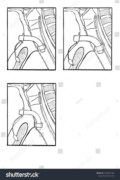 Diagrams Position Tracheostomy Tube Stock Illustration 1636831285