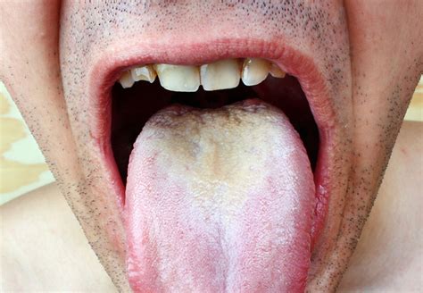 Thrush — The White Stuff Growing In Your Mouth And How To Get Rid Of