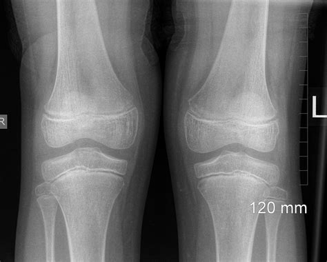 Normal Knee Buyxraysonline