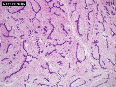 Qiaos Pathology Juvenile Fibroadenoma Of Breast（乔氏病理学：青少 Flickr