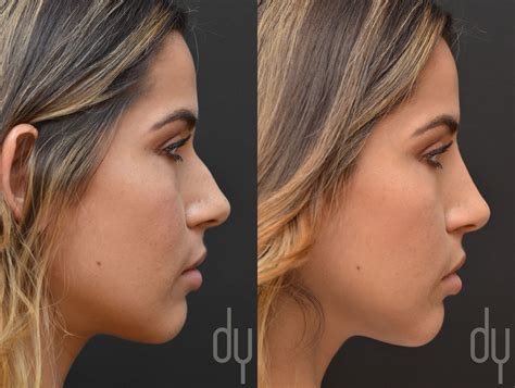 Pin By Selam On Cirugia Plástica Rhinoplasty Nonsurgical Nose Job