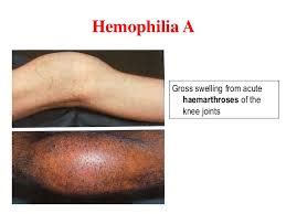 De symptomen zijn afhankelijk van de ernst van hemofilie. Hemophilia | Mexico| PDF | PPT| Case Reports | Symptoms ...