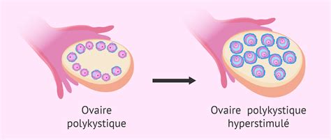 Hyperstimulation Ovarienne Avec Un Sopk