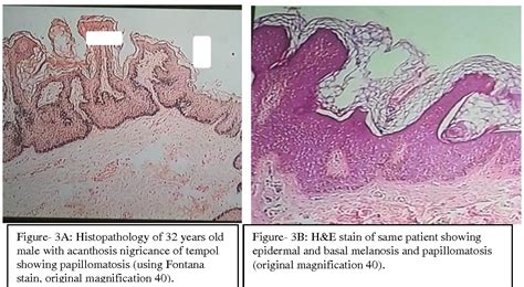 Figure 3 From Acanthosis Nigricans As A Cause Of Facial M Elanosis