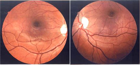 Fundus Photographs Of The Right Eye Left Image And Left Eye Right