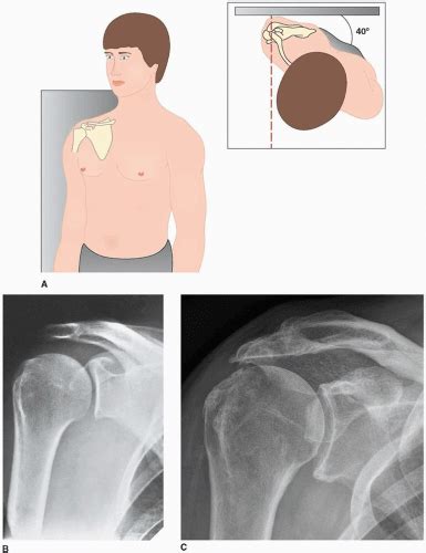 Shoulder X Ray Views Epomedicine
