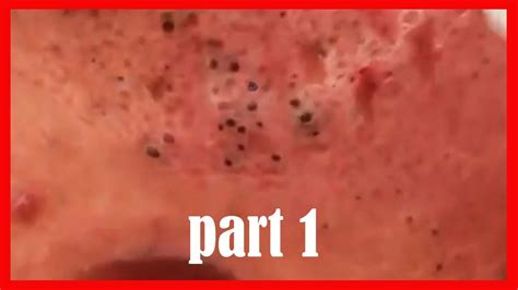 Most Satisfying Pimples And Blackheads Removal Videos 2 Part 1 Youtube