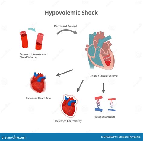 Hypovolemic Cartoons Illustrations And Vector Stock Images 37 Pictures