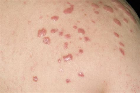 Keloid Scars In Acne Vulgaris Photograph By Dr P Marazziscience Photo