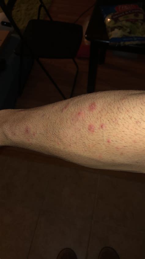 Acnefolliculitis On Forearms Please Help General Acne Discussion