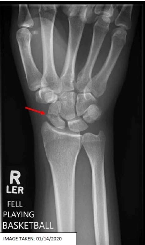 Cureus Conservatively Managed Displaced Scaphoid Fracture In A Young