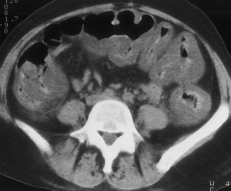 Pseudomembranous Colitis Spectrum Of Imaging Findings With Clinical