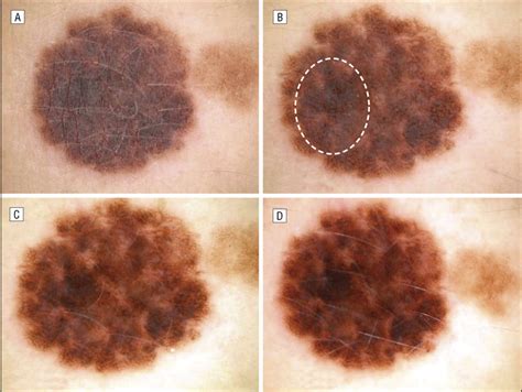 A Dysplastic Nevus Shown By Clinical Photography A Nonpolarized