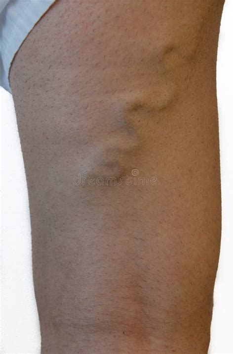 Varicose Veins On A Leg Stock Image Image Of Standing 69945465