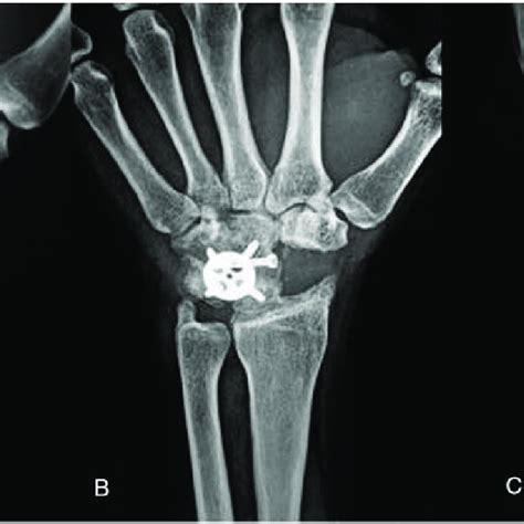 X Ray Image Of The Treated Fracture Year After Operation Download Scientific Diagram