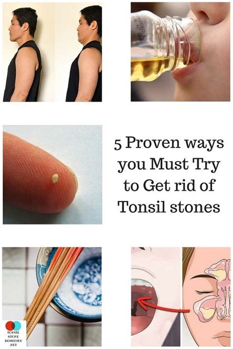 Pin On Tonsil Stones Remedies