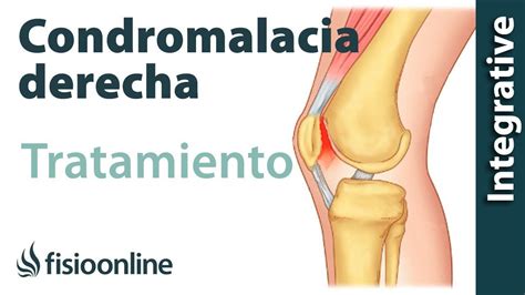 Tratamiento De La Condromalacia Rotuliana Derecha Fisioonline