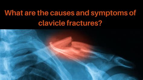 What Are The Common Causes And Symptoms Of A Clavicle Fracture Youtube