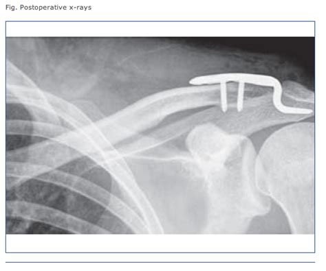 Shoulder And Elbow Surgery Shoulder Separation Or Collar Bone