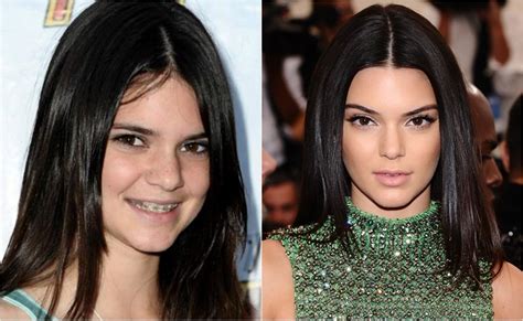 Kendall Jenner Antes Y Despues