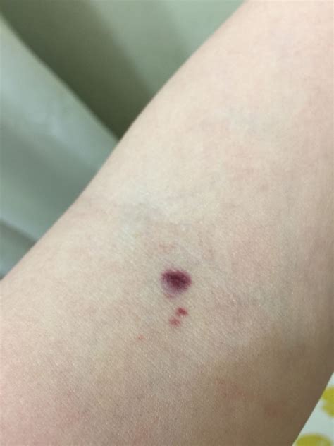 Flat Painless Purple Spot Just Appeared On My Inner Elbow It Happens