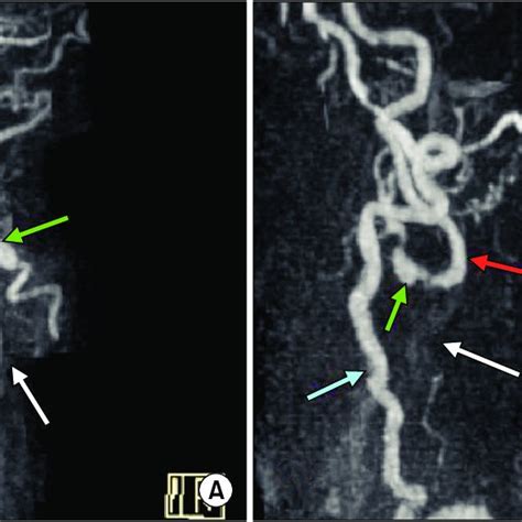 PDF Symptomatic Bilateral Carotid Artery Occlusion An Uncommon