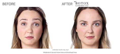 Botox 1 Fda Approved Treatment For Reducing Fine Lines And Wrinkles