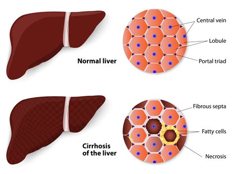 Assess Liver Fibrosiscirrhosis In Singapore Dr Benjamin Yip