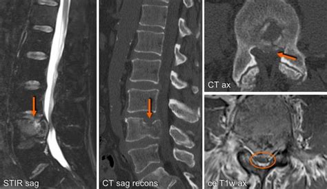 9 An L4 Vertebral Lesion Replacing Fatty Marrow Mass With An