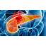 Three Drugs Beats Two In Advanced Pancreatic Cancer