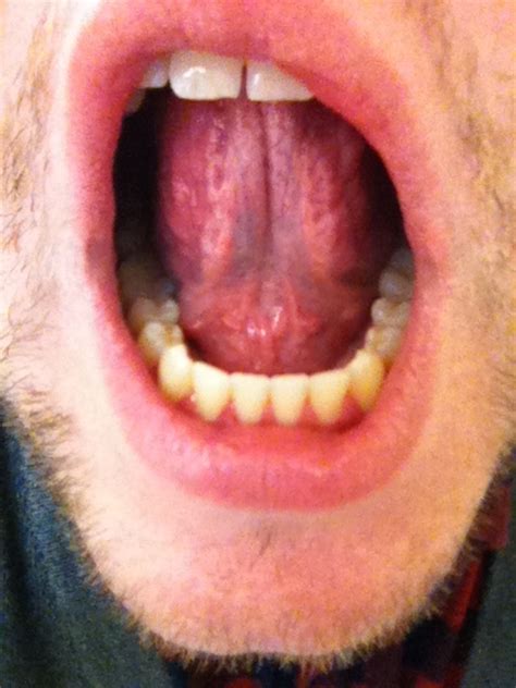 Lump On Floor Of Mouth Under Tongue Home Alqu