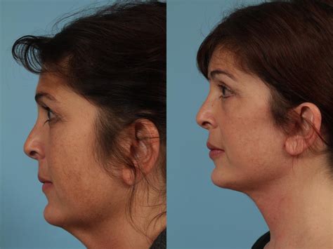 Neck Lift Before And After Photos Patient 332 Chicago Il Tlkm