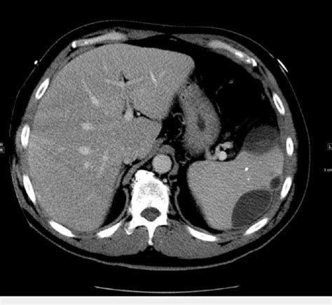 Splenic Abscess A Computed Tomography Ct Of The Chest And Abdomen