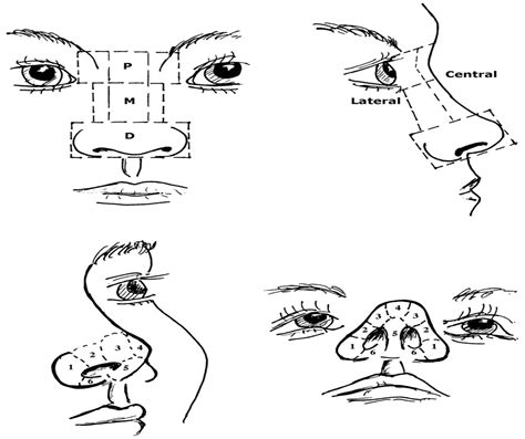 Nasal Reconstruction With Local Flaps A Simple Algorithm Fo
