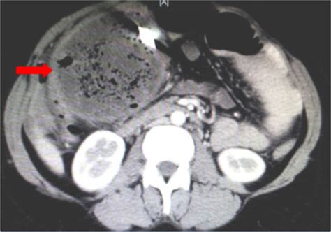 Ct Scan Of The Abdomen Showing A Sponorm Circumscribed Encapsulated