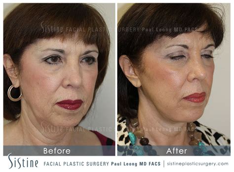 Facelift Before And After 18 Sistine Facial Plastic Surgery