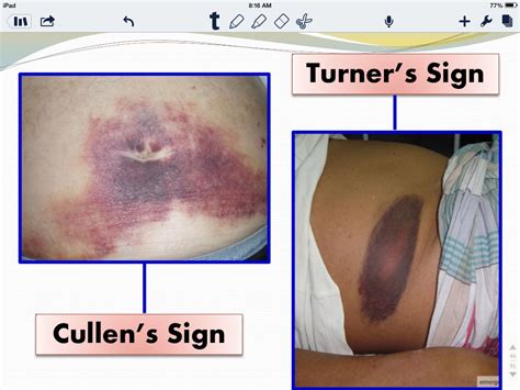 Sinal De Grey Turner