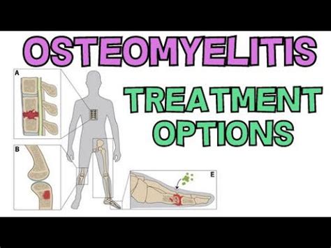 HOW TO TREAT OSTEOMYELITIS FAST OSTEOMYELITIS TREATMENT AND RISK