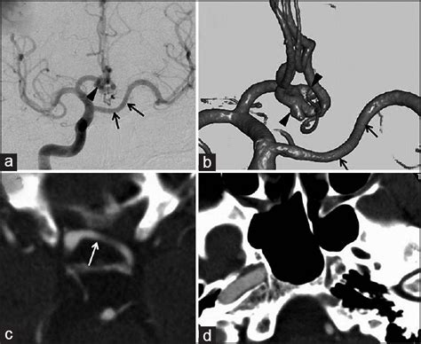 Agenesis Of The Internal Carotid Artery With Transcavernous Anastomosis Associated With Anterior