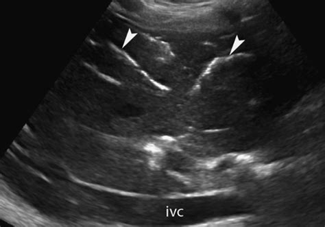 What Is Hepatobiliary Tree Ultrasound