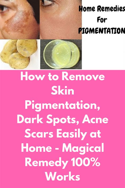 Pin On Acne Scar Removal Creams