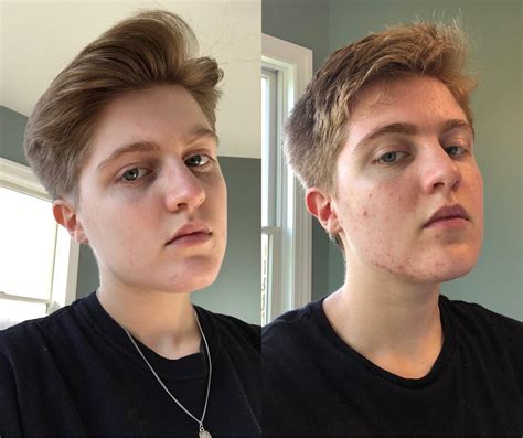 2 Years Ago Vs Today 4 Months On T Hormonal Jawline Acne Represent